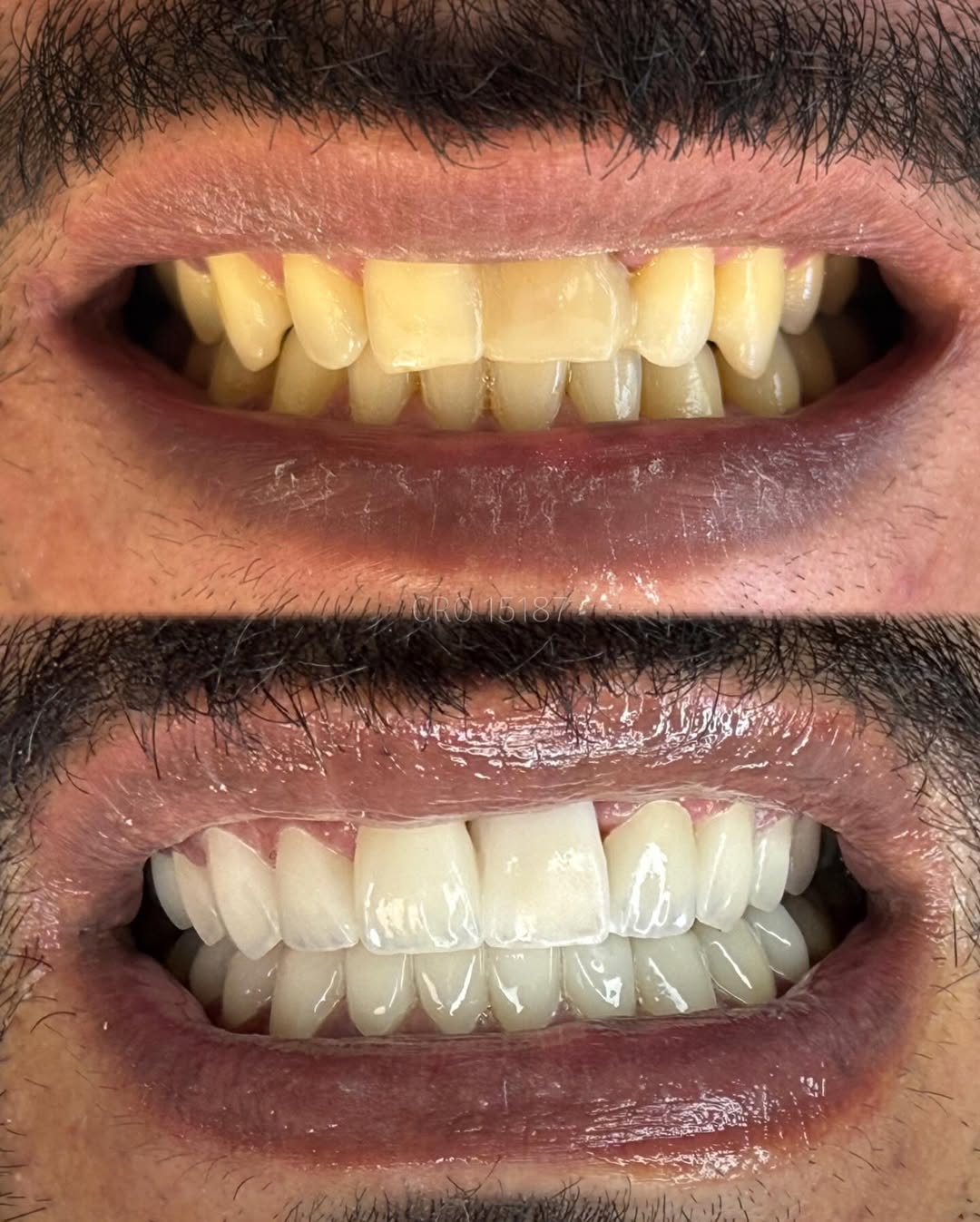 Laminados em Porcelana